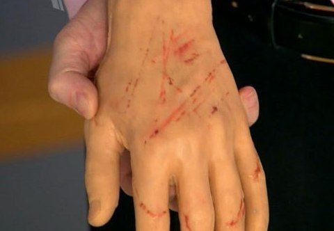 Болезнь кошачьих царапин