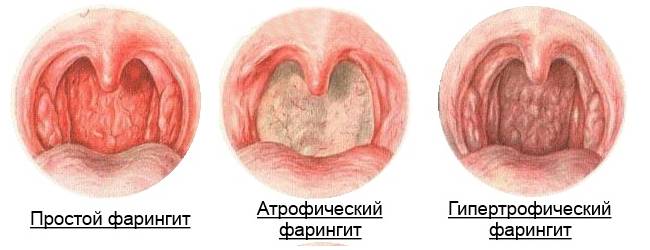 Имудон - инструкция по применению, аналоги, отзывы и формы выпуска (таблетки для рассасывания) лекарственного препарата для лечения ангины, стоматита и фарингита у взрослых, детей и при беременности