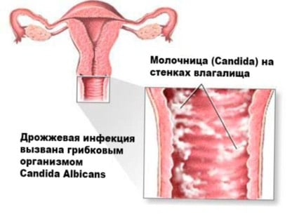 Вагинит. причины, симптомы, признаки, диагностика и лечение болезни.