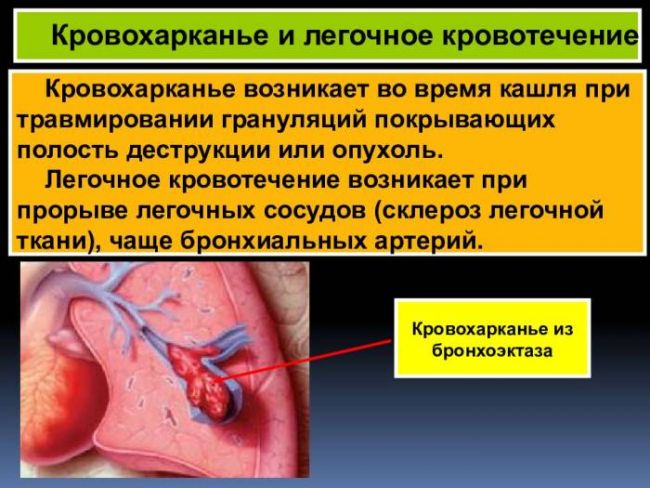 Кровохарканье: понятие, причины и формы, проявления, диагностика, лечение