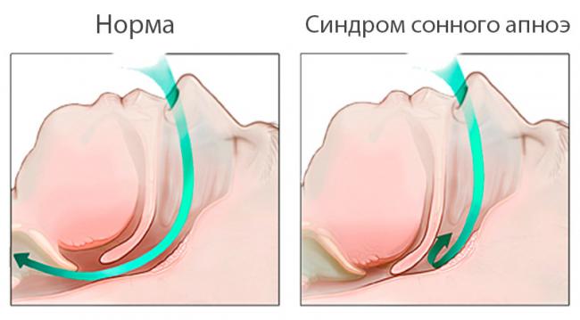 Синдром апноэ во сне