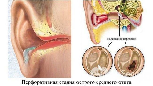 Как долго лечат отит у детей?