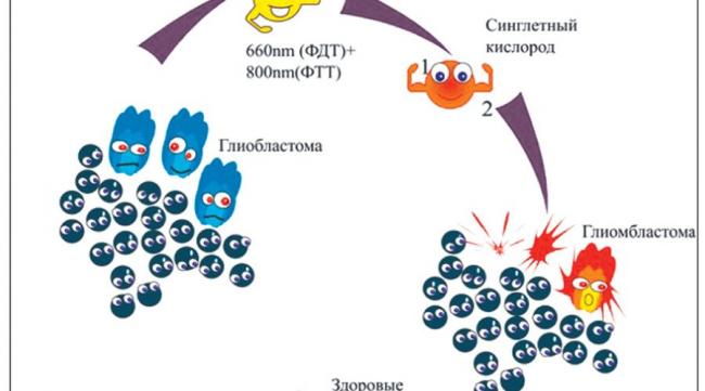 Прогноз срока жизни с глиобластомой головного мозга последней стадии и после операции