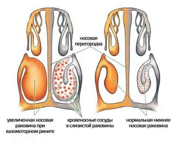 Вазомоторный ринит: симптомы и лечение