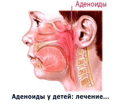 Как понять что у ребенка аденоиды симптомы: симптомы 1,2, 3 степени.