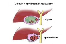 Что такое холецистит и его лечение