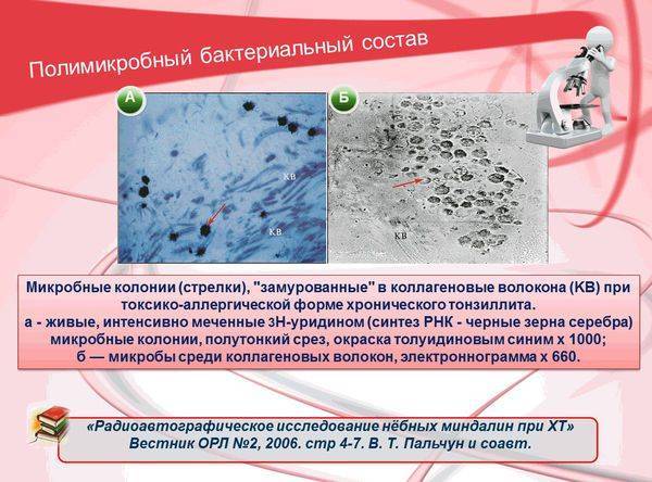 Хронический субкомпенсированный тонзиллит