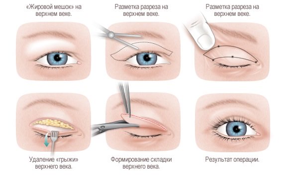 Что делать, если после ботокса опустилось верхнее веко?