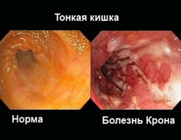Что можно есть после рвоты ребенку: диета при и после рвоты у малыша чем можно кормить, а чем нельзя