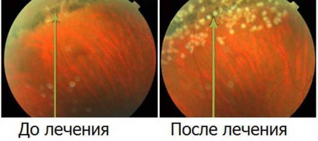 Периферические витреохориоретинальные дистрофии