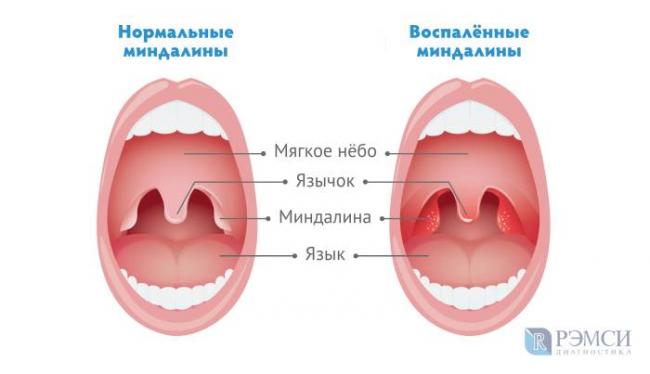 Чем лечить воспаление слизистой горла и гортани