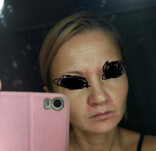 Красные чешущиеся пятна на теле