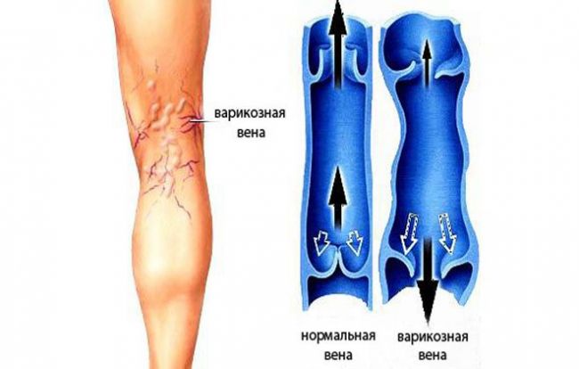 Тромбы в сосудах