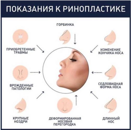 Ринопластика носа безоперационная, закрытая, открытая, реконструктивная, инъекционная, реабилитация
