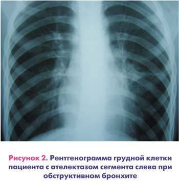 Обструктивный бронхит у детей - симптомы и лечение