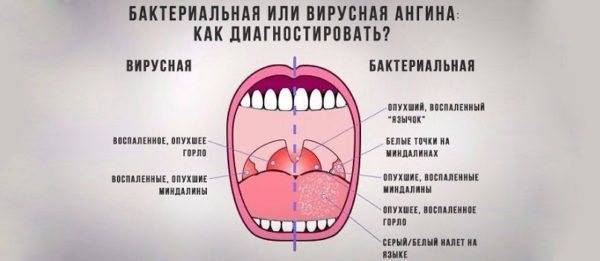 Ангина у детей: болезнь коварная, но лечится — в два счета!