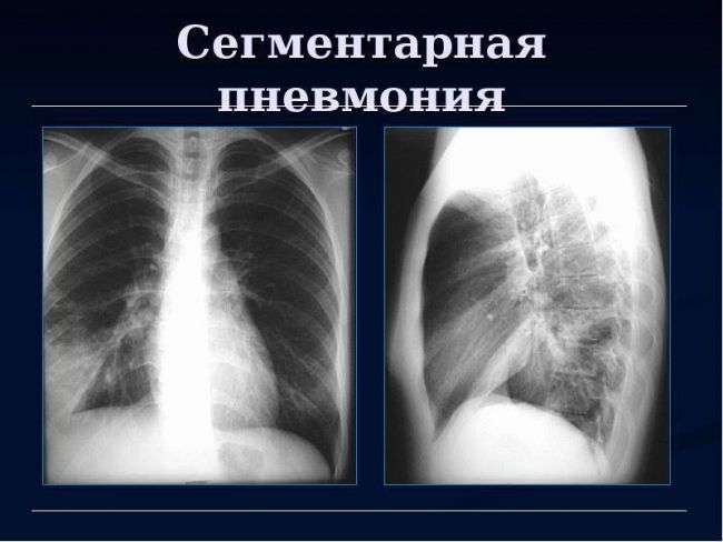 При сильном кашле болит левый бок под ребрами
