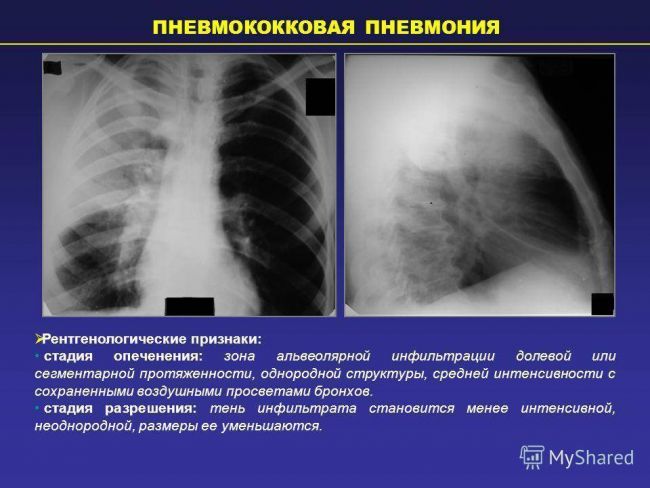 Рентген легких и флюорография легких — все что нужно знать