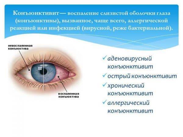 Гноятся глаза у взрослого чем лечить народными средствами
