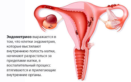 Киста яичника – образование которое можно остановить