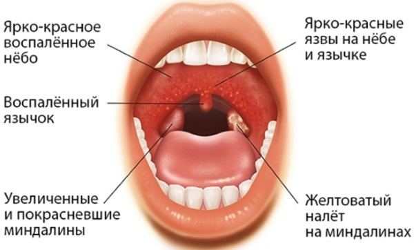 Симптомы хронического тонзиллита: признаки, лечение | food and health