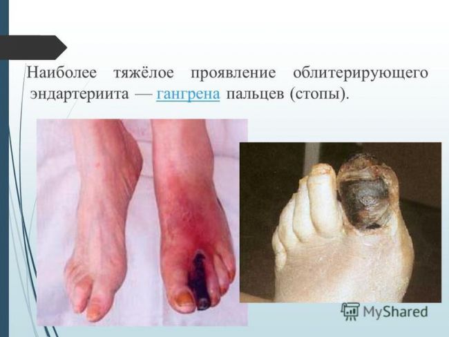 Облитерирующий эндартериит — лечение рекомендует профессор