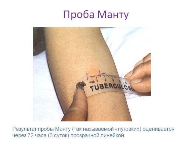 Все о прививке манту