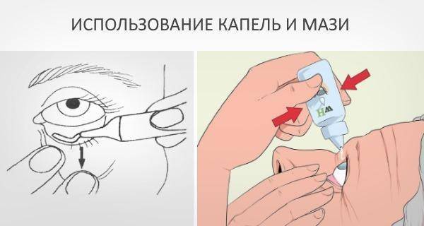 Аденовирусный конъюнктивит народными средствами