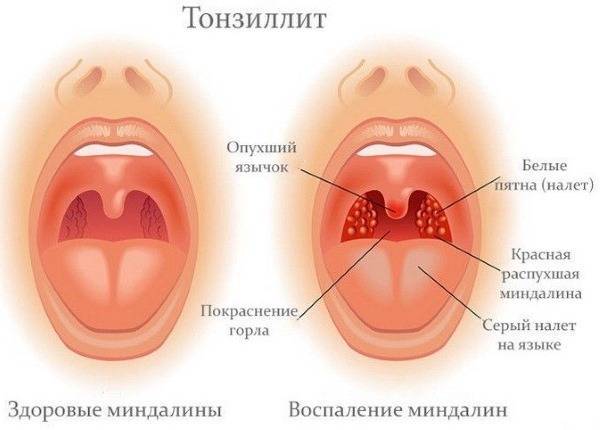 Как быстро начинает действовать антибиотик при ангине у ребенка