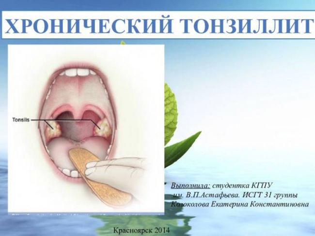 Причины возникновения и лечение хронического декомпенсированного тонзиллита