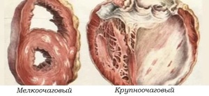  атеросклеротический кардиосклероз: симптомы и лечение. атеросклеротический кардиосклероз: почему возникает эта форма ибс и как ее лечить.