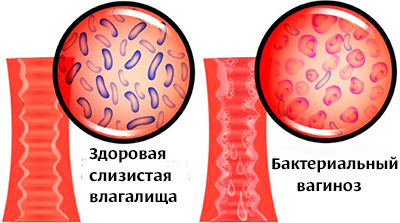 Что такое бактериальный вагиноз, как проявляется, чем его лечить?
