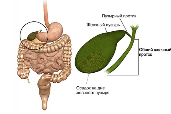 Сладж в желчном пузыре лечение