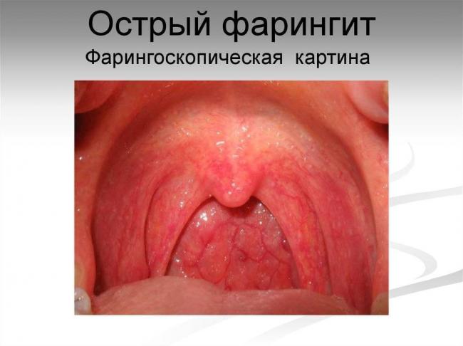 Болезни горла и гортани – причины, симптомы, лечение и профилактика