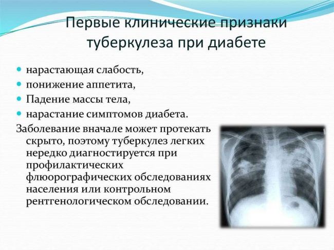 Лечение туберкулеза при сахарном диабете