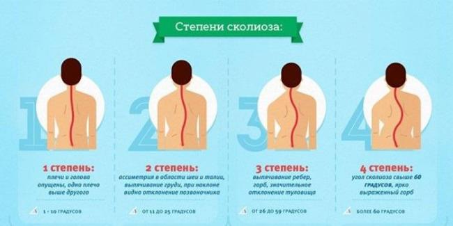 Какие упражнения нельзя делать при сколиозе: список противопоказаний при заболевании