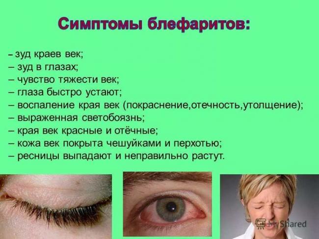 Блефарит симптомы и лечение каплями