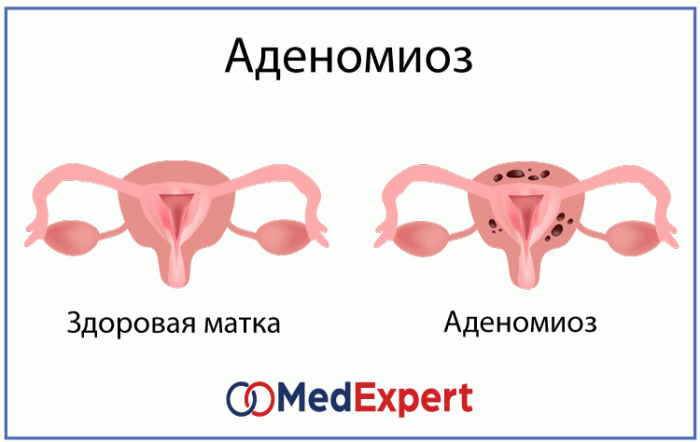 Аденомиоз матки: формы, степени, факторы и природа заболевания