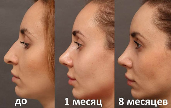 Ринопластика