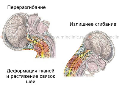 Лечение компрессионного перелома поясничного отдела позвоночника