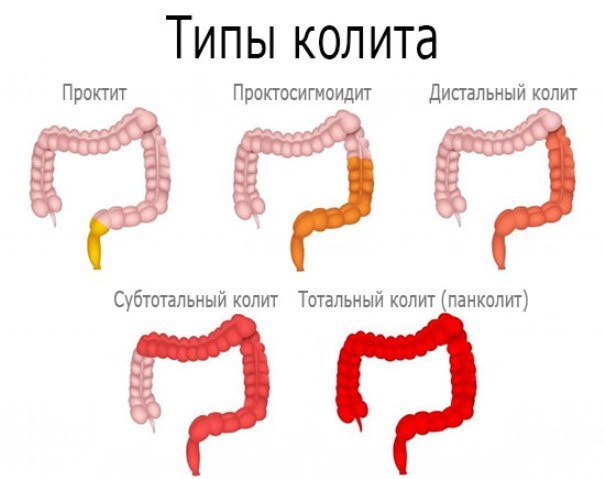 Питание при хроническом гастрите и колите