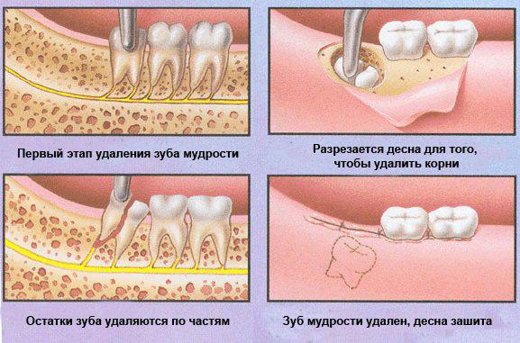 Удаление зубов мудрости. правила и рекомендации.