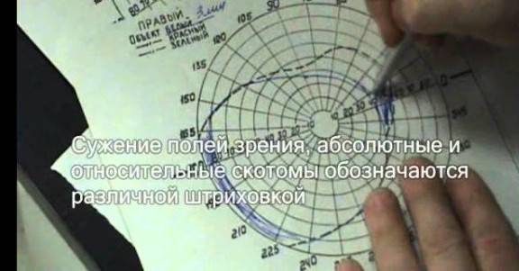 Периметрия