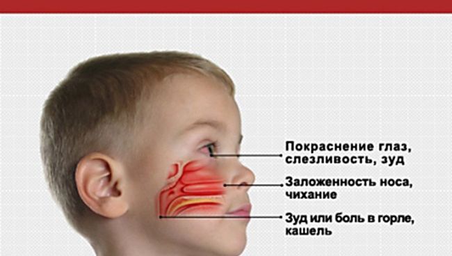 Аллергический ринит: симптомы и лечение у взрослых