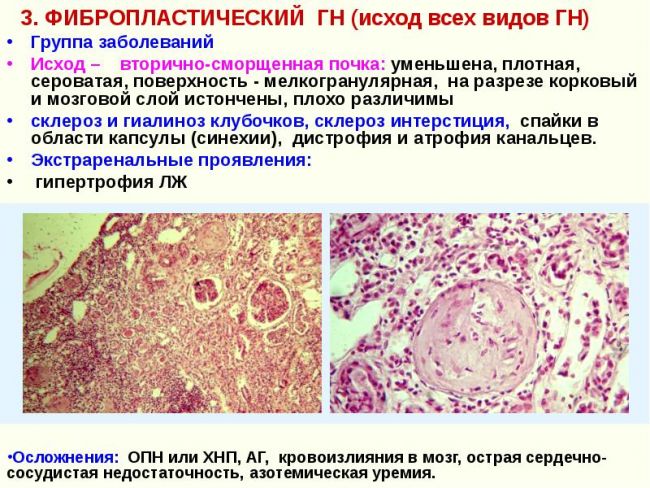 Нефросклероз (сморщенная почка): нефросклероз (сморщенная почка)