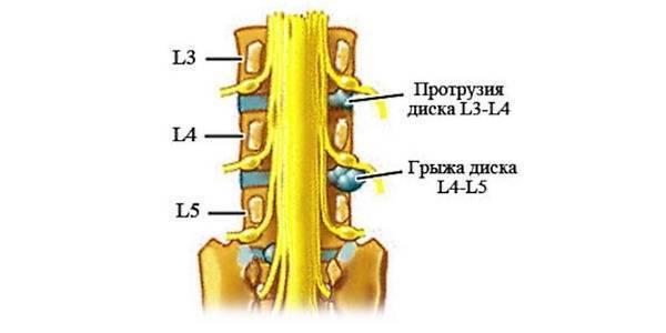 Как лечить протрузию дисков l4-l5 и l5-s1