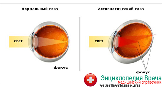 Астигматизм