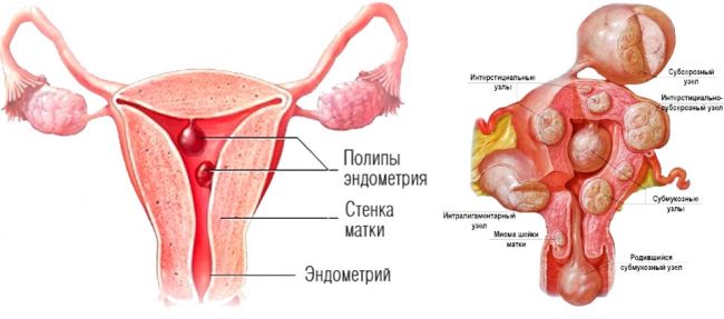 Полип шейки матки: симптомы и лечение, фото, операция по удалению