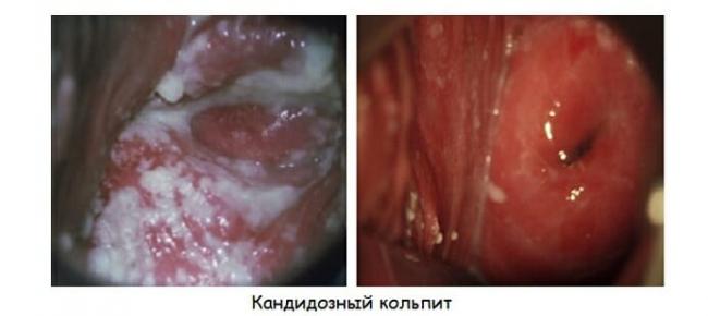 Симптомы и лечение кольпита (неспецифического вагинита)