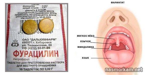 Фурацилин для горла при ангине, в чем эффективность полоскания